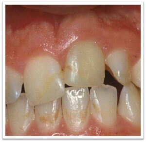 外傷後の癒着切歯の歯冠修復_図1