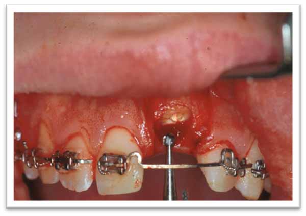 外傷後の癒着切歯の歯冠修復_図2