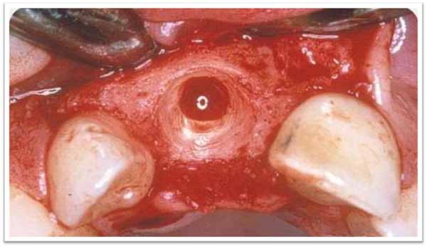 外傷後の癒着切歯の歯冠修復_図3