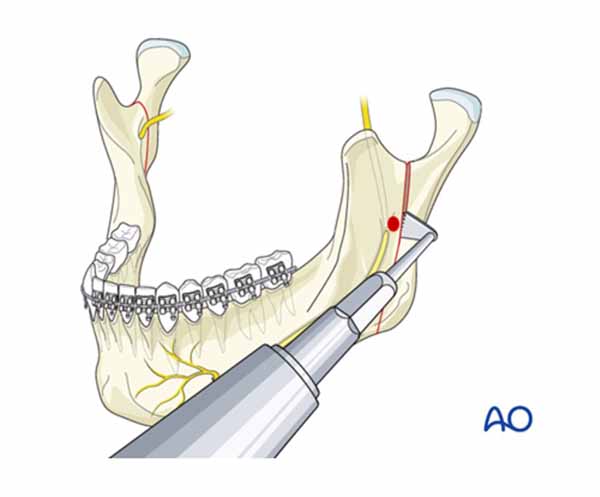 口腔内垂直枝骨切り術(IVRO)_図1