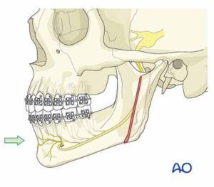 口腔内垂直枝骨切り術（IVRO）_図2