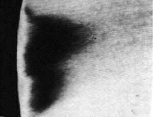 虫歯検出、追加方法_図1