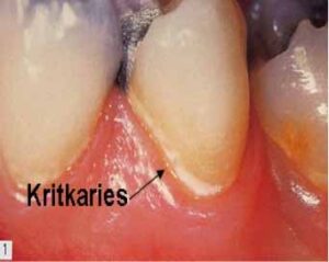 虫歯検出、追加方法_図2