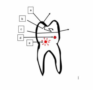 虫歯検出、追加方法_図4