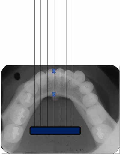 歯科X線写真における正常な解剖学_図1