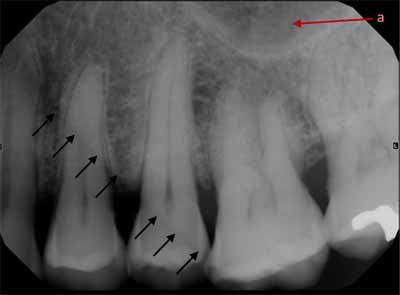 歯科X線写真における正常な解剖学_図10