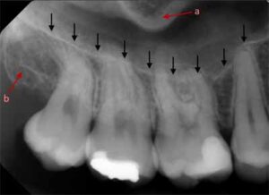 歯科X線写真における正常な解剖学_図11