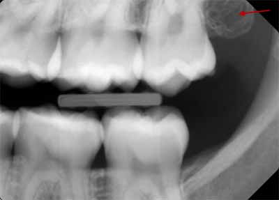 歯科X線写真における正常な解剖学_図12