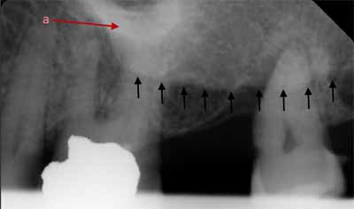 歯科X線写真における正常な解剖学_図13