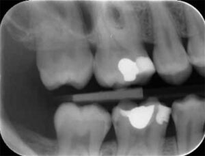 歯科X線写真における正常な解剖学_図14