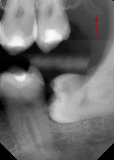 歯科X線写真における正常な解剖学_図15