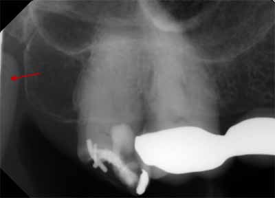 歯科X線写真における正常な解剖学_図16