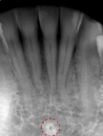 歯科X線写真における正常な解剖学_図17a