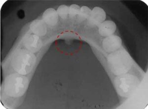 歯科X線写真における正常な解剖学_図17b