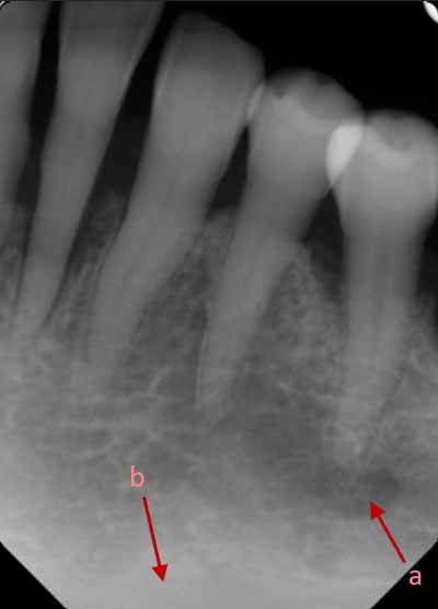 歯科X線写真における正常な解剖学_図18