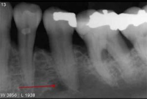 歯科X線写真における正常な解剖学_図19