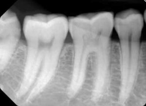 歯科X線写真における正常な解剖学_図2