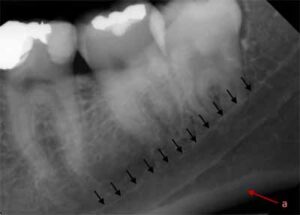 歯科X線写真における正常な解剖学_図20