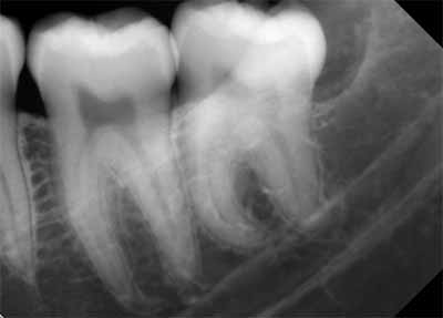 歯科X線写真における正常な解剖学_図21