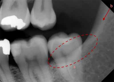 歯科X線写真における正常な解剖学_図23