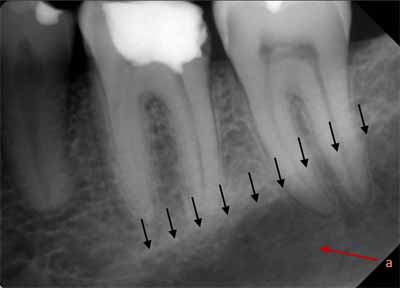 歯科X線写真における正常な解剖学_図24