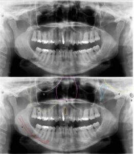歯科X線写真における正常な解剖学_図26