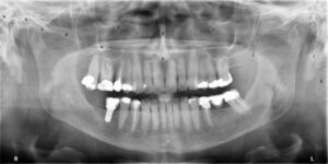 歯科X線写真における正常な解剖学_図27a