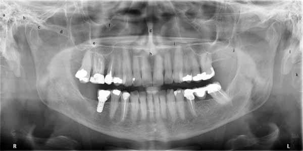 歯科X線写真における正常な解剖学_図27a