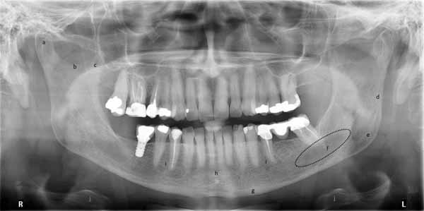 歯科X線写真における正常な解剖学_図27b