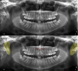 歯科X線写真における正常な解剖学_図28