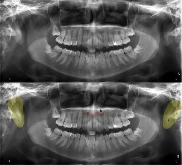 歯科X線写真における正常な解剖学_図28
