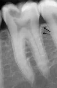 歯科X線写真における正常な解剖学_図3