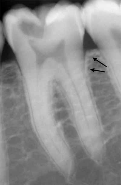 歯科X線写真における正常な解剖学_図3