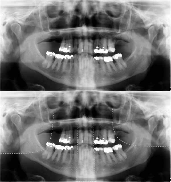 歯科X線写真における正常な解剖学_図30