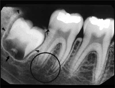歯科X線写真における正常な解剖学_図4