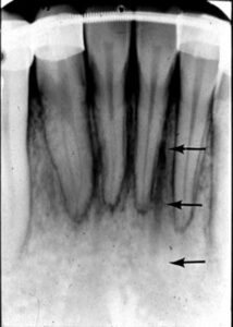 歯科X線写真における正常な解剖学_図5