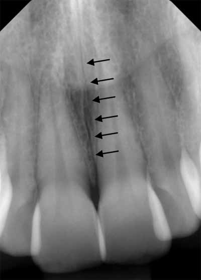 歯科X線写真における正常な解剖学_図6