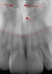 歯科X線写真における正常な解剖学_図7