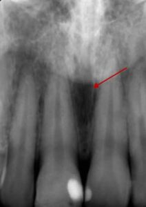歯科X線写真における正常な解剖学_図8a