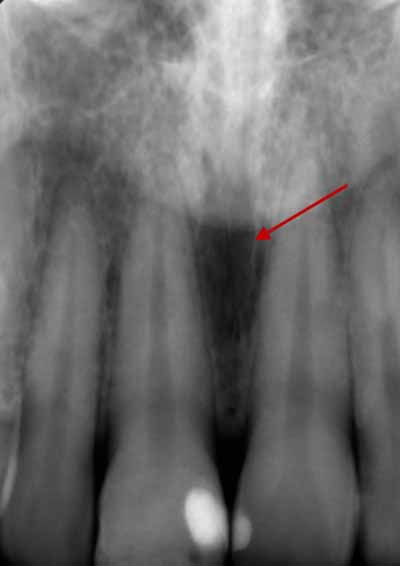 歯科X線写真における正常な解剖学_図8a