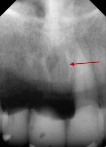 歯科X線写真における正常な解剖学_図8b