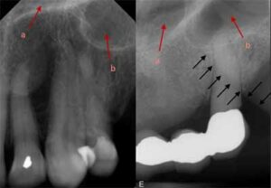 歯科X線写真における正常な解剖学_図9