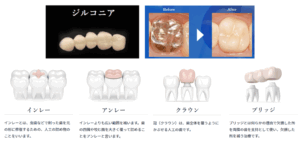 銀歯・補綴・セラミック・アんれー・インレー・クラウン 料金30%OFF