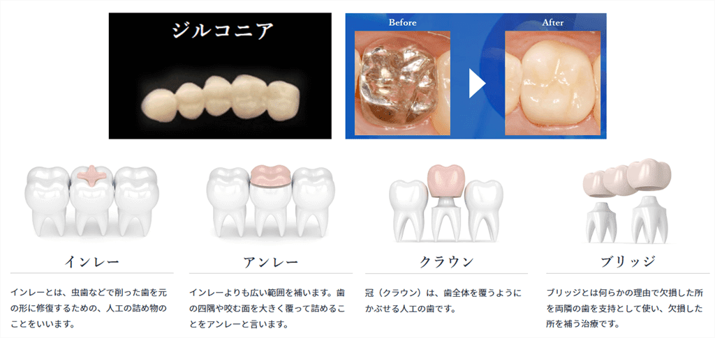 銀歯・補綴・セラミック・アんれー・インレー・クラウン 料金30%OFF