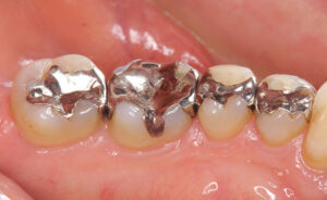 原因不明の頭痛や不眠、実は『銀歯』の電流かもしれません。歯科金属が引き起こすガルバニー電流（口腔内電流）のメカニズムと、全身への影響