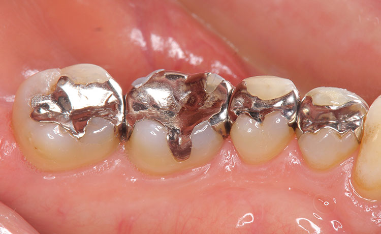 原因不明の頭痛や不眠、実は『銀歯』の電流かもしれません。歯科金属が引き起こすガルバニー電流(口腔内電流)のメカニズムと、全身への影響