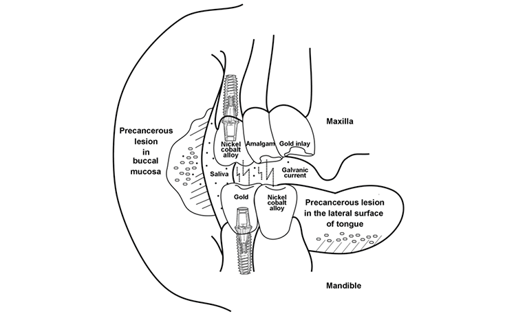 ガルバニー電流の基本原理(口腔内での電池現象)