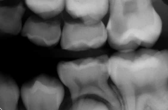 小児・青少年歯科における基礎検査。年齢に応じた基礎検査の間隔と検査内容_図3