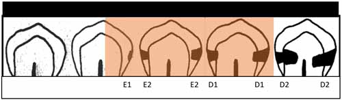 プラスチックベースの材料による、空洞のないエナメル質および象牙質の隣接面のう蝕の封鎖_図1