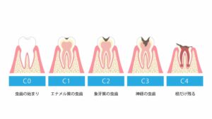 永久歯の虫歯の掘削から歯髄病変まで
